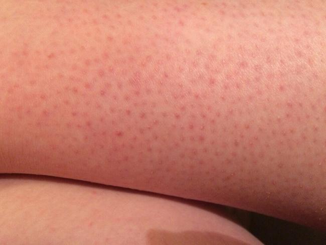 Ever wondered what those red bumps are?