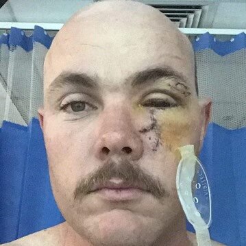 ‘The second surgery sucked the most because I had to get the retina reattached’. Picture: Contributed