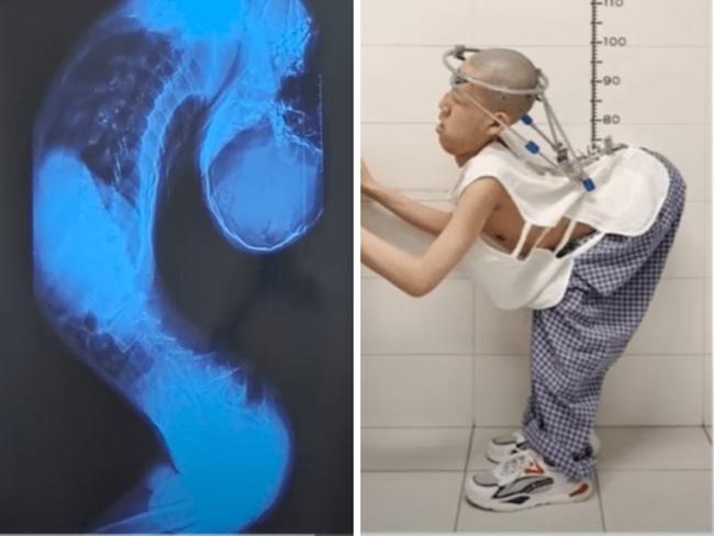 A student with a debilitating spinal condition that twisted his body into a Z-shape is one step closer to standing straight after multiple high-risk surgeries. Picture: YouTube/South China Morning Post