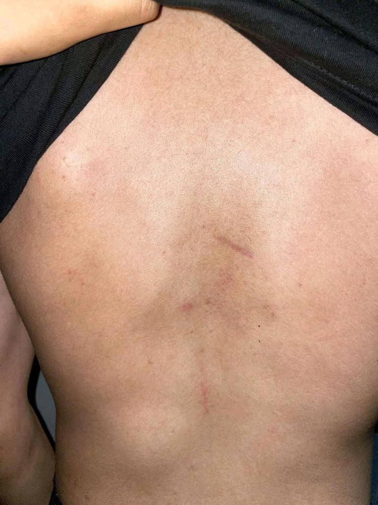 Bruises on the boy’s back. Picture: supplied