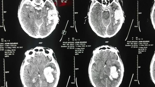The CAT scan of injured Aussie John Burke. The white patches show bleeding in his brain. Picture: Supplied.