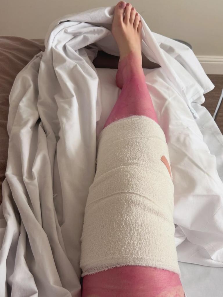 Her leg had turned bright pink. Picture: Instagram