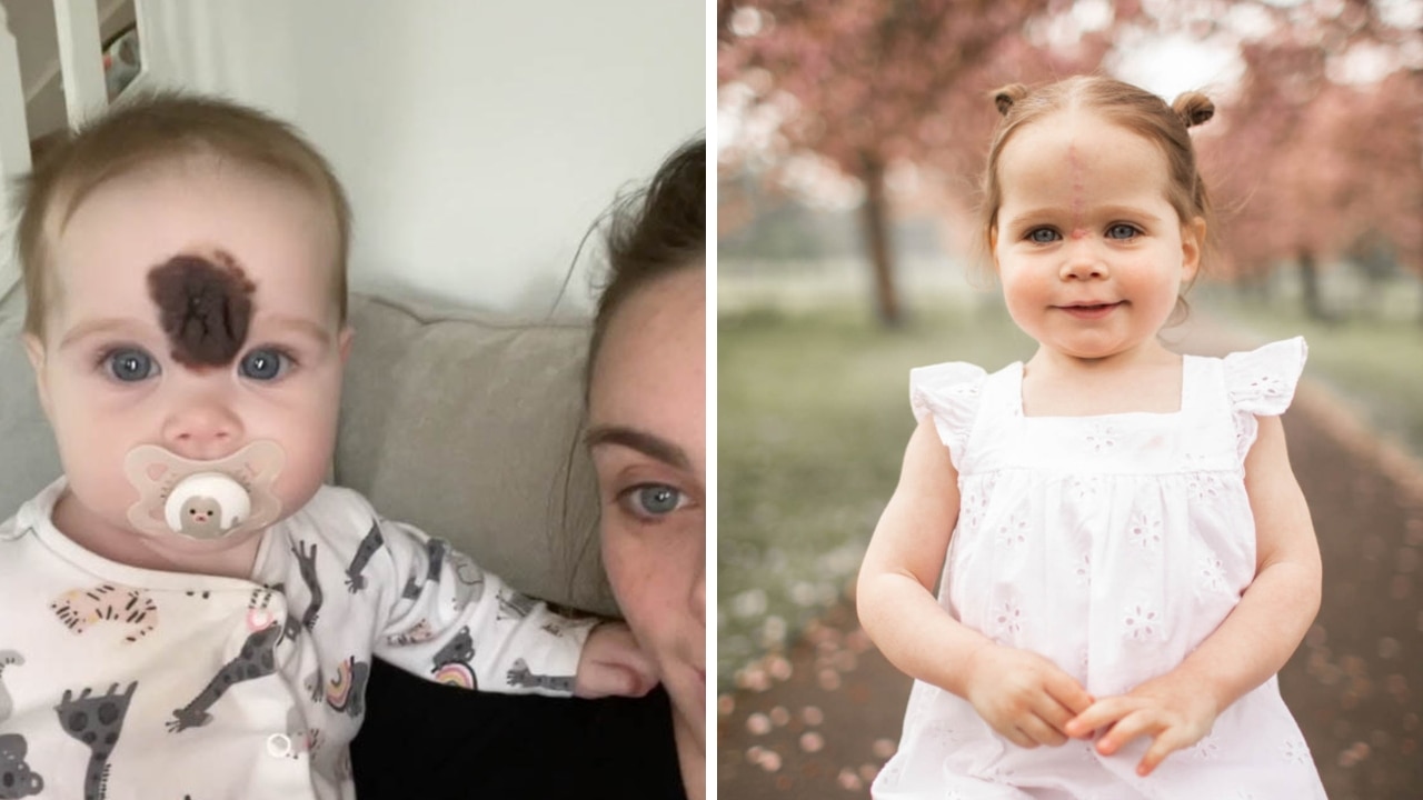 People Told Her To Remove Her Birthmark, But She Chose To Embrace It  Instead