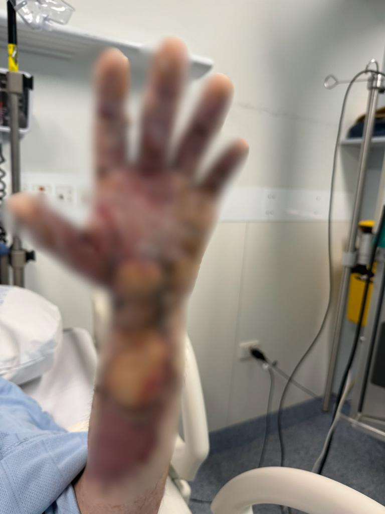 Lauchlan had to undergo extensive reconstruction surgery to repair his arms.