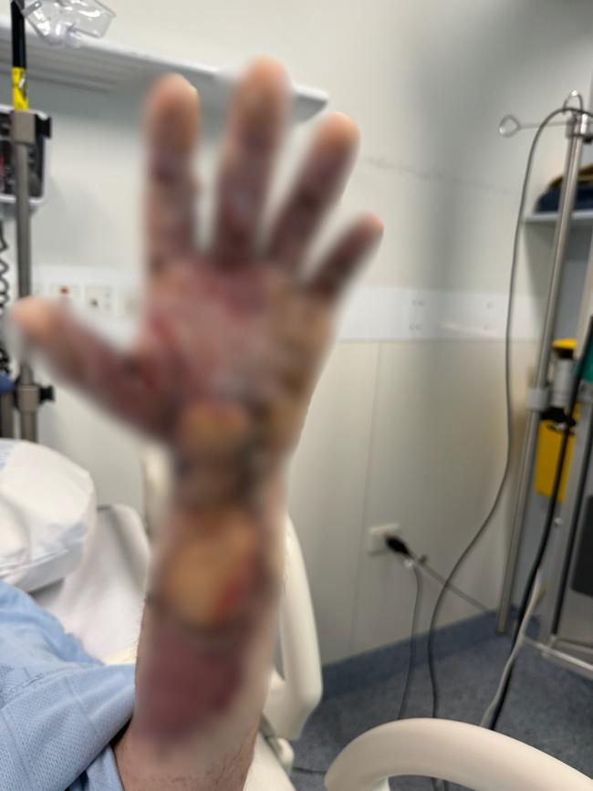 Lauchlan had to undergo extensive reconstruction surgery to repair his arms.
