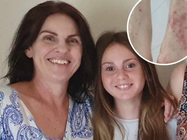 A Brisbane mum of three has revealed that she tried to take her own life due to her struggle living with a severe skin condition.