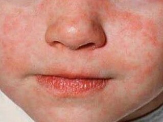 Measles is highly contagious.