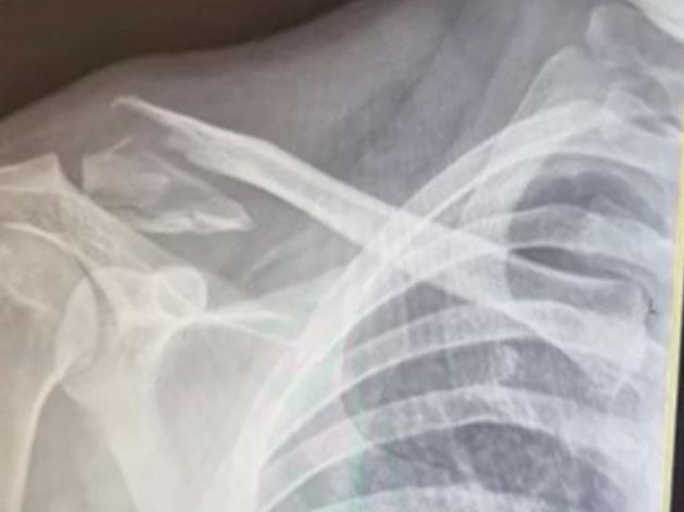Lachlan Steger, 25, visited WhiteWater World last year, and what started off as a fun day out quickly spiralled into an emergency situation while riding the Triple Vortex. Lachlan i  is preparing to take a popular Gold Coast theme park to court after he broke his collarbone on one of its rides. PIcture: 7NEWS