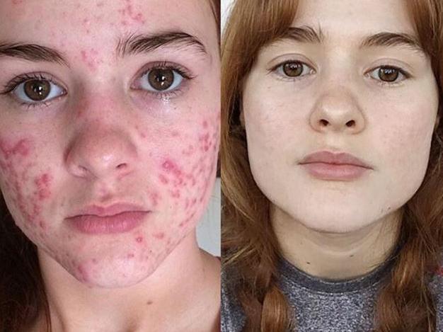 Before and After she went on acne drugs.