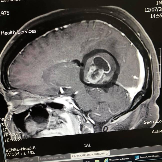 An earlier scan showed how the cancer had spread into Melinda's brain.