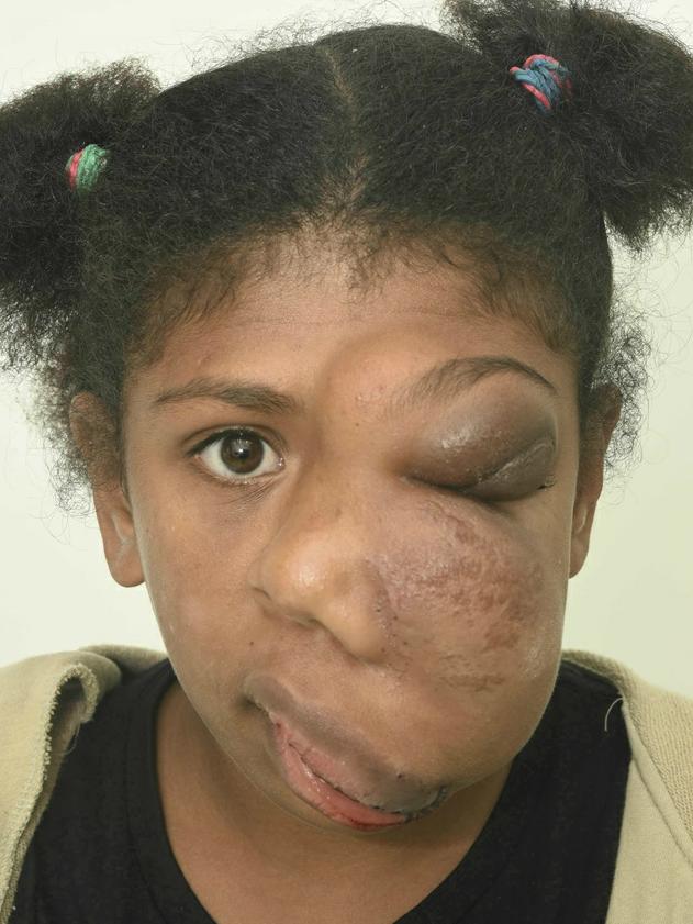 Vanuatu teen Jelsian Sur before reconstructive surgery at the Queensland Children's Hospital.