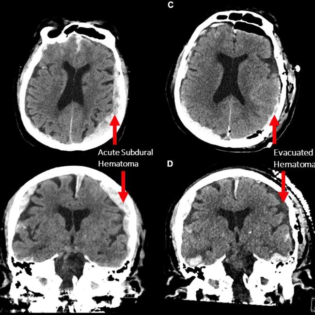 First-ever recording of a dying human brain reveals what happens when we die. Picture: Frontiers in Aging Neuroscience