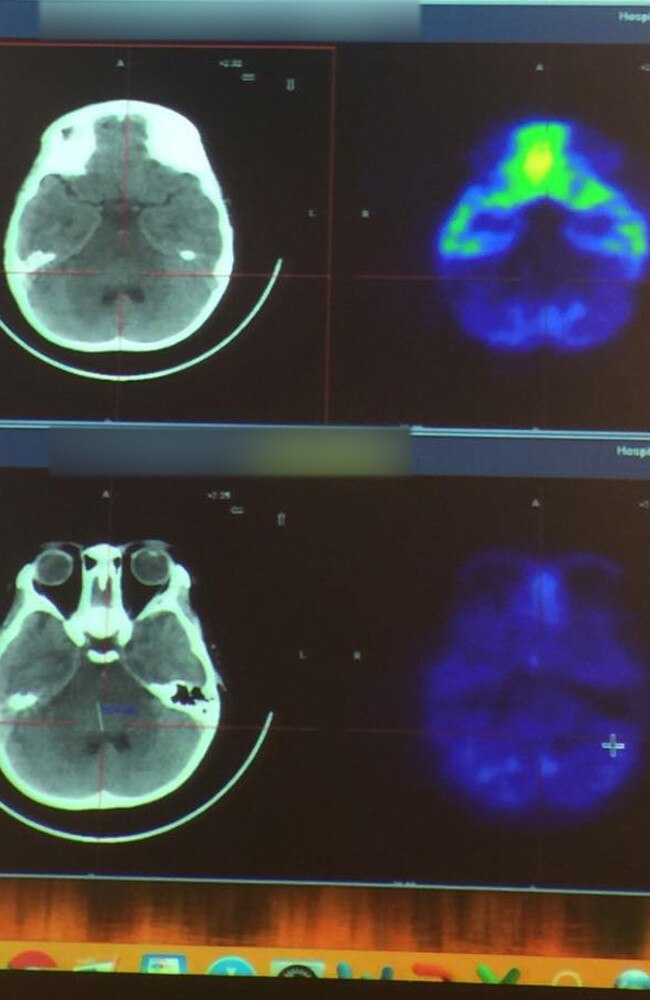 Annabelle Nguyen’s scans after a recent MRI scan.