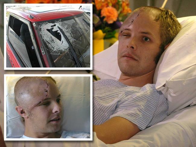 Damien de Wit's injuries after his skull was crushed by a rock thrown at a car.