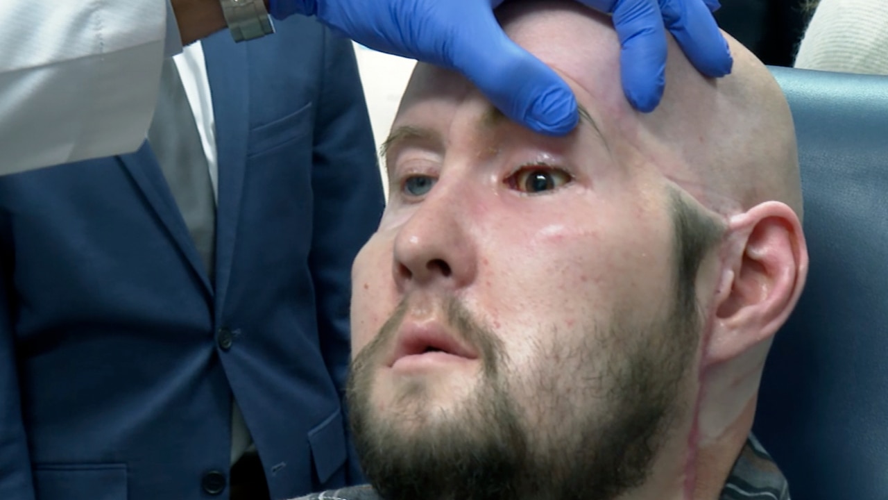 History made as man receives world’s first wholeeye transplant The