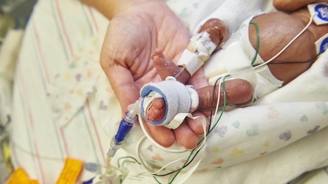 The Top End toddler was born extremely prematurely at around 24 to 25 weeks — rather than a full term of 37 weeks. Picture: Supplied