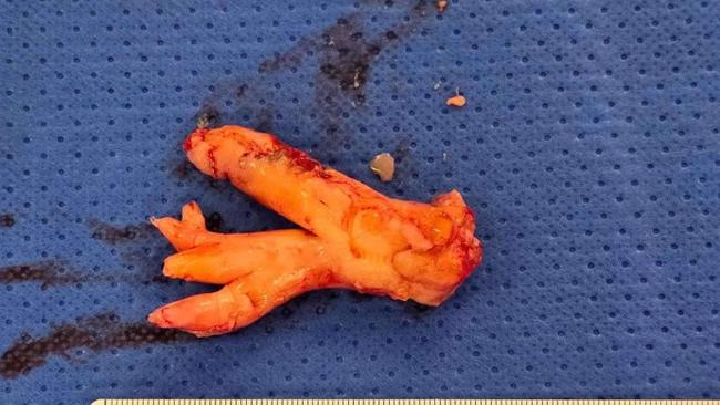 The tumour that was removed from Christine Boyle's pulmonary artery. Picture: Supplied