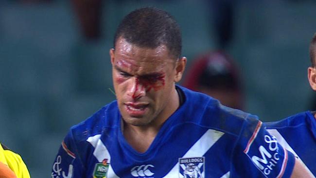 Will Hopoate comes off with concussion.