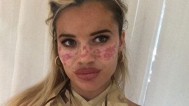 Tilly showed fans her scars from the attempted beauty hack. Picture: Instagram