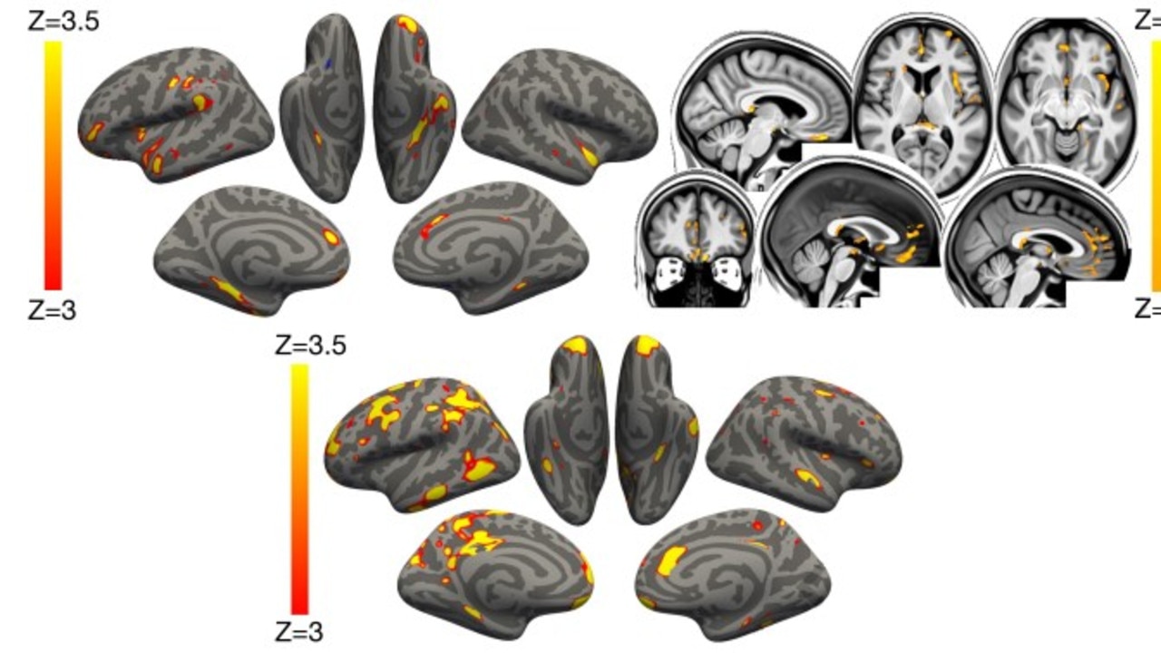 Yellow and red areas show the difference in grey matter thickness. Z represents the amount of change from normal levels. Picture: supplied