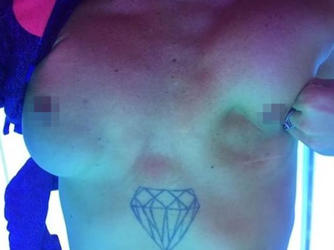 While she was in a tanning bed Amanda discovered that the implants moved around and “disappeared” under her skin. Picture: Caters