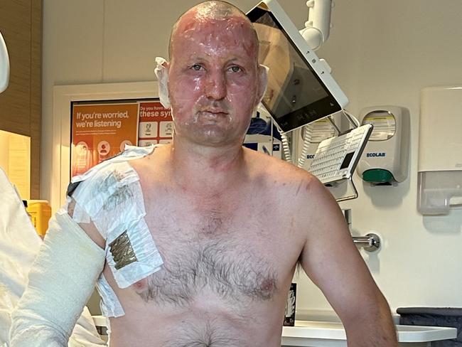 Adelaide man Adam Boots was burnt six months ago pouring accelerant onto a bonfire. Picture Supplied