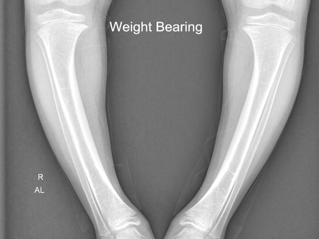 A rare kidney disease caused Bindisa Powaseu to develop bowed legs. An X-ray of her legs before recent surgery at the Queensland Children’s Hospital. The surgery will hopefully cause her legs to straighten over time.