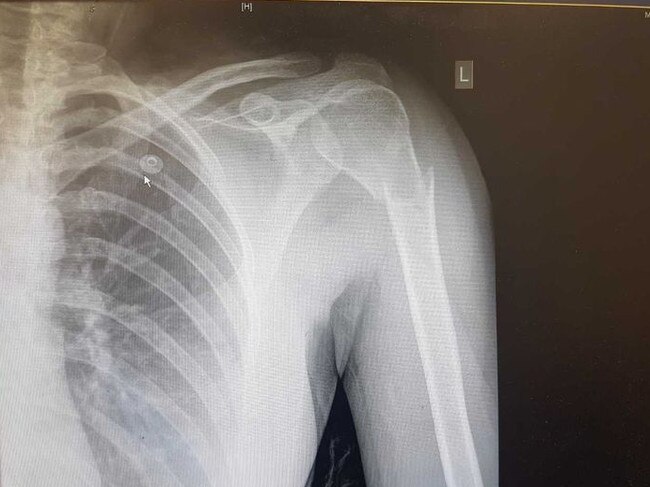 Molan’s X-ray shows the bone completely broken in two. Picture: 9 News