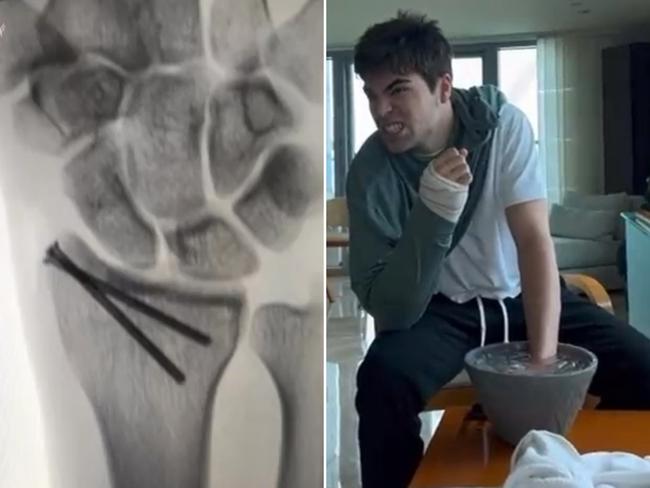 (L-R) An X-Ray of the injury and Lance Stroll details his rehab.