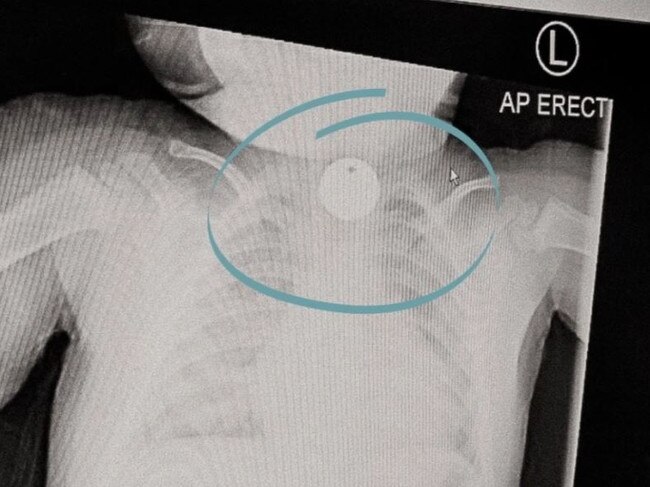 Baby critical after swallowing aldi token. Picture: tinyheartseducation