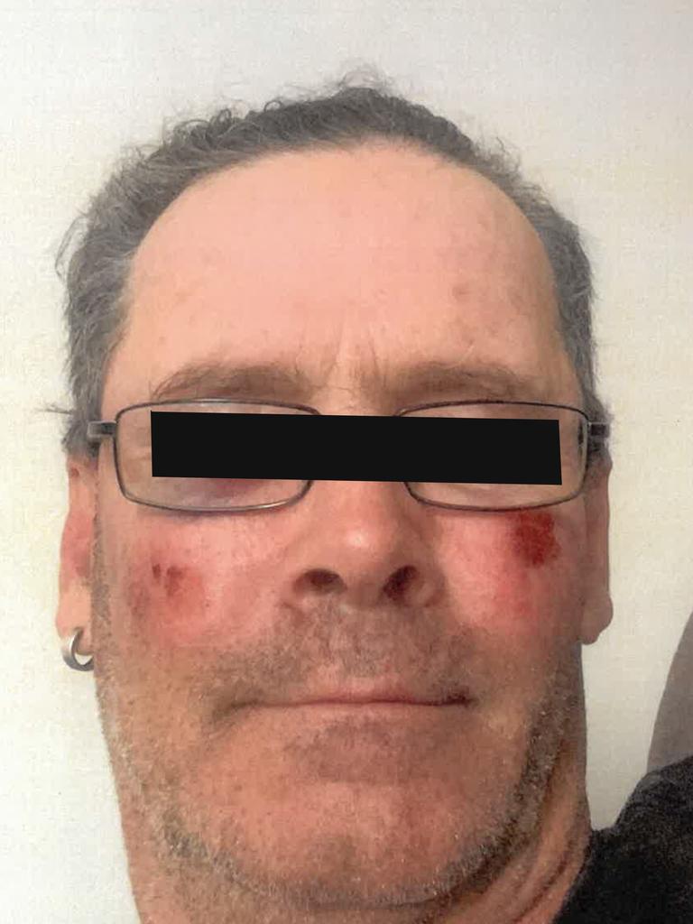 The victim of Andrew Martini’s assault as he recovered. Pictures: supplied