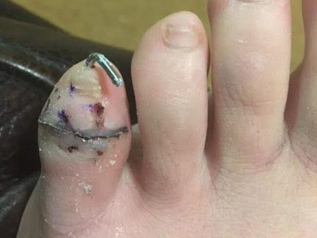 Stephanie told how she was off work for six weeks and had to wear a boot, so that the pin could work its way out of her toe.