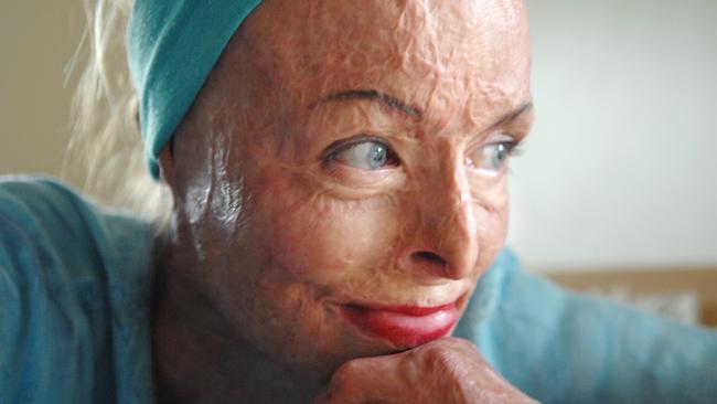 Carol Mayer survived a horrific house fire that left her with severe burns to 85 per cent of her body.