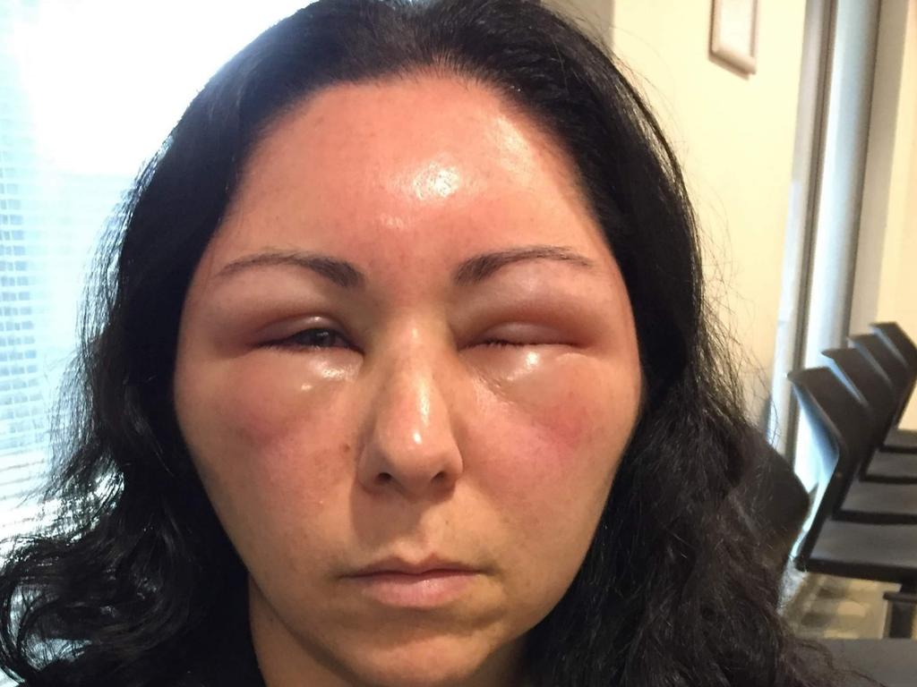 Womans Head Swells Like A Balloon After Shocking Allergic Reaction To