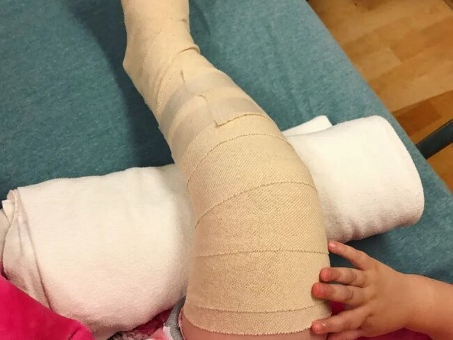 The two-year-old smashed into the concrete ground and her thigh bone was snapped in half. PICTURE: Instagram/mamabearreview