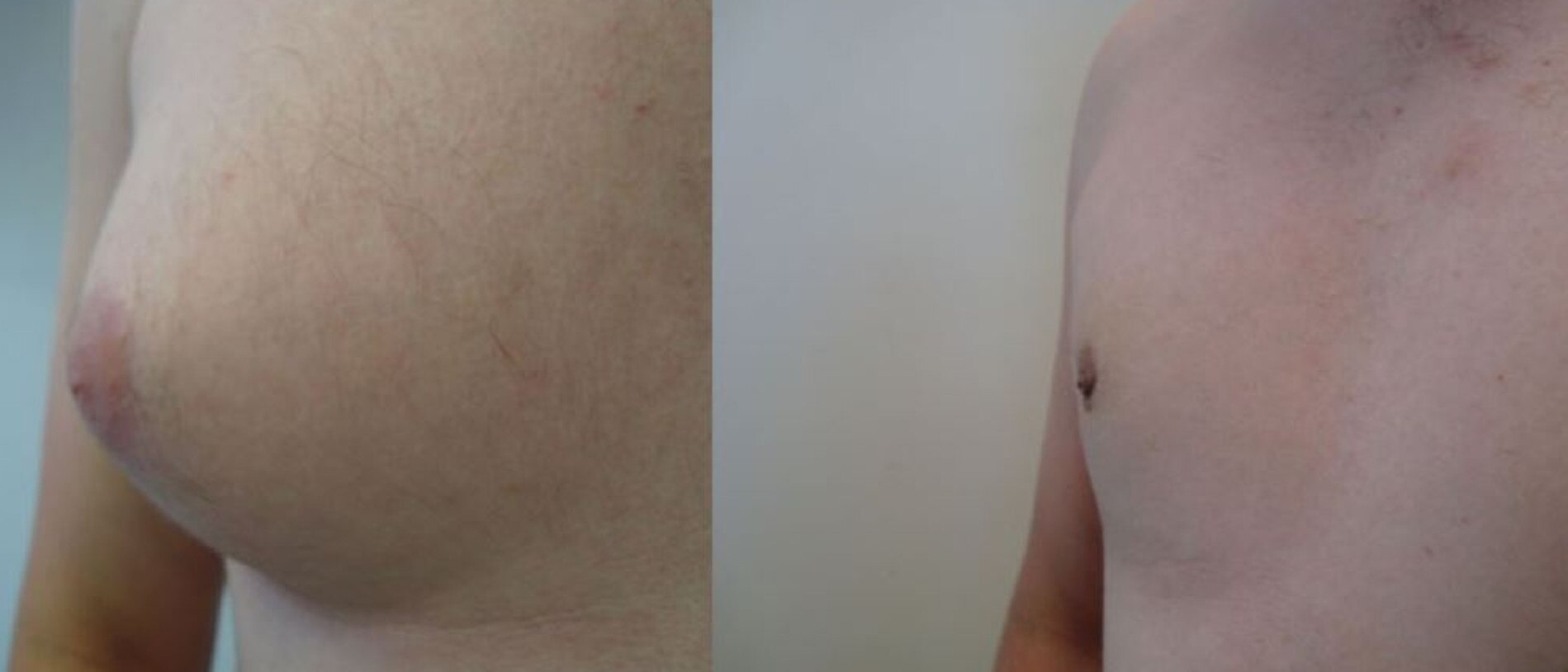 Before and after ‘man boob’ surgery.