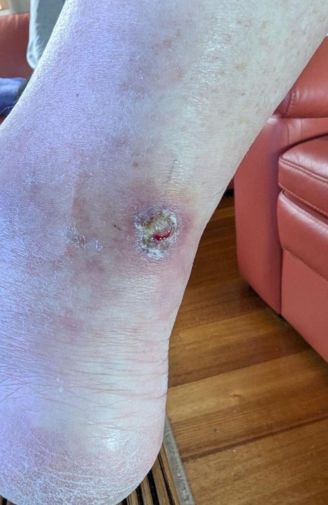 Geoffrey Mutton's healing ulcer. Picture: Supplied