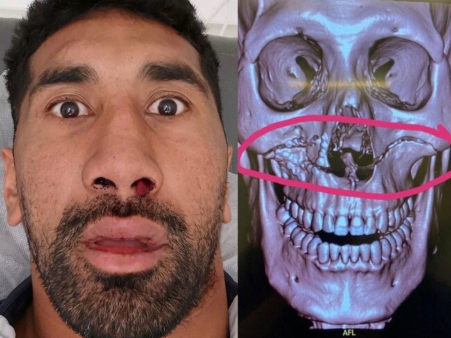 Sia Soliola's facial fracture needed surgery to repair.