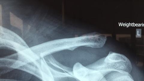 Robbie Farah: Shoulder x-Ray Photo supplied