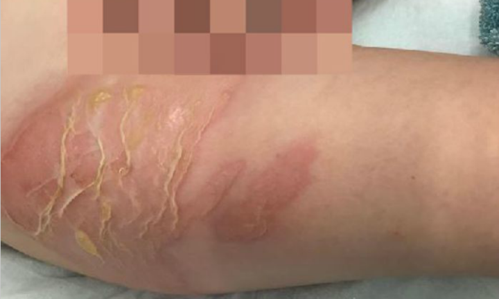 Dermatologist Explains How to Cope with Toasted Skin Syndrome