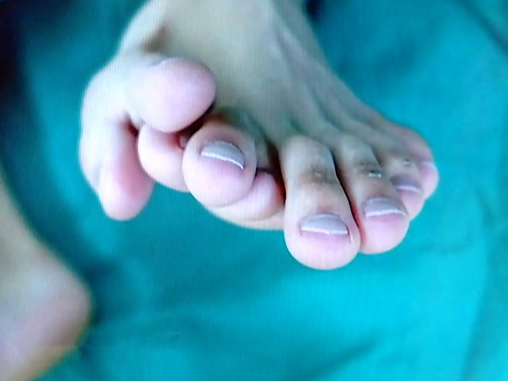 Eventually he sought help as he was desperate to get a girlfriend, but he thought no one would date him because of his unusual foot. Picture: Asiawire/Australscope