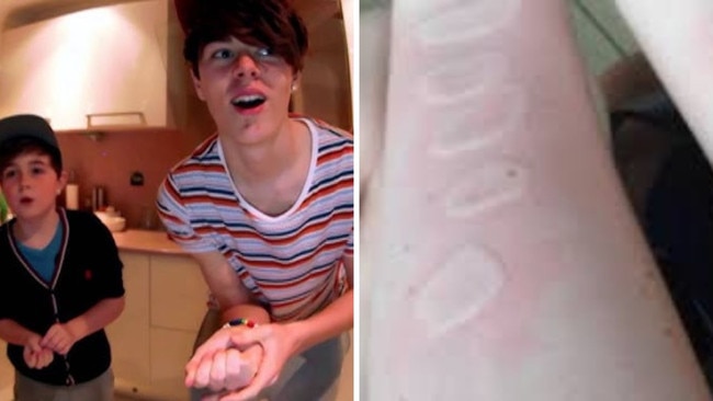 The Salt and Ice Challenge: placing salt on a bare patch of skin, usually the forearm, and pressing ice on top of it. The combination causes an intense burning sensation and, in some cases, leads to severe skin damage, including frostbite and chemical burns. Picture: YouTube