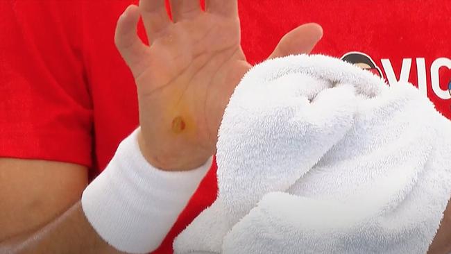 Novak Djokovic hands with blisters.