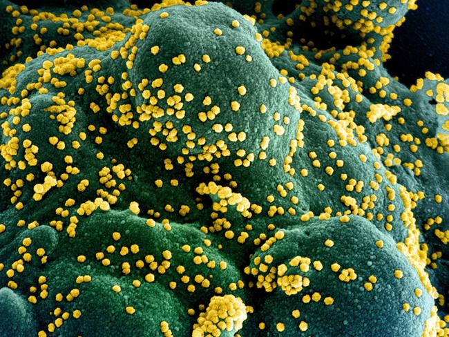 (FILES) In this undated handout image obtained July 15, 2020, courtesy of National Institute of Allergy and Infectious Diseases(NIH/NIAID), shows a colorized scanning electron micrograph of an apoptotic cell (blue/green) heavily infected with SARS-COV-2 virus particles (yellow), isolated from a patient sample, captured at the NIAID Integrated Research Facility (IRF) in Fort Detrick, Maryland. - US pharmaceutical company Eli Lilly's combination of two synthetic antibodies against Covid-19 reduced hospitalizations and deaths by 70 percent in high-risk patients with recent positive tests, the company said on January 26, 2021. 