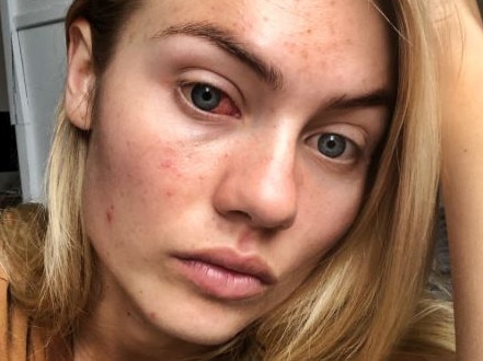 Days after model Elyse Knowles shared confronting images of her painful eye surgery, the Myer ambassador took to her Instagram account again, this time revealing details about her ongoing skin battle.