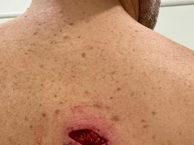 The open wound on Fevola’s back sent him straight to the emergency department. Picture: Supplied