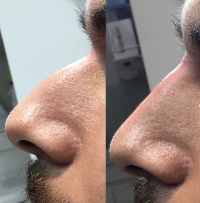 Nose reshaping by Dr Ingrid Tall using dermal fillers at Cosmetic Image Clinics.