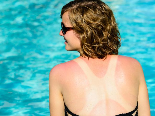 A smiling female sitting next to a pool with a tan line and sunburn on her back.