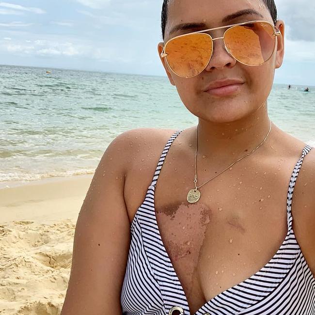 Sofi Leota in January 2019, showing her scars, when she found out she was in remission. Source: Instagram