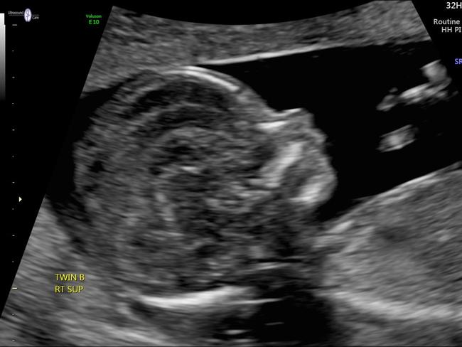 A scan of Fiona Ellis-Jones’ stillborn baby Elizabeth.